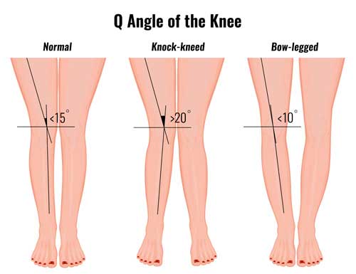 Q Angle pada kaki manusia